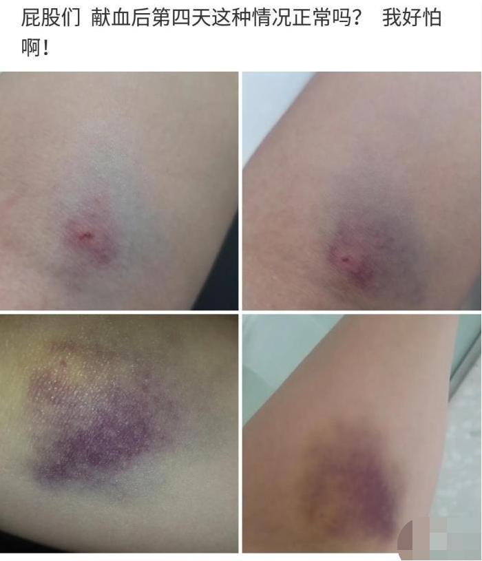 “献血之后，手腕就变成这样了！有人知道是啥情况吗？太吓人了！”